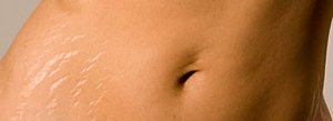 Stretch-marks-1